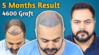 Patient Review After 5 months || Hair Transplant in Bhopal || 4600 Graft || Hair Transplant Result.