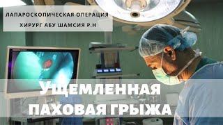 Ущемленная косая паховая грыжа. Лапароскопическая операция в Consilium Medical