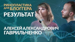 Ринопластика результат. Пластическая хирургия. Клиника Дега.