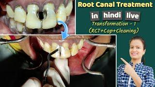 root canal treatment