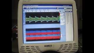 Transcranial doppler - TCD - Rimed