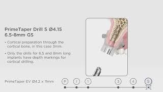 PrimeTaper - Guided Surgery procedure