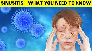 Sinusitis - Causes, Pathogenesis, Signs & Symptoms, Diagnosis, And Treatment