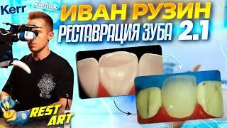 Реставрация зуба 2.1 - Иван Рузин | RestART