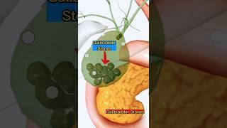 Gallbladder Stones 3D Animation |Medical| #3d #medical