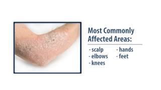 Common Skin Disorders- Eczema & Psoriasis