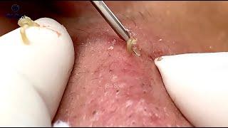 If You Like Squeezing Acnes, You'll Must be See This Video | Part 1 | GaSpa 10.03.2022