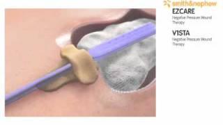 Negative pressure wound therapy .wmv
