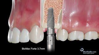 BSB Bio Max Forte 3.7 Implant