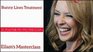 Bunny lines treatment with Botulinum toxin