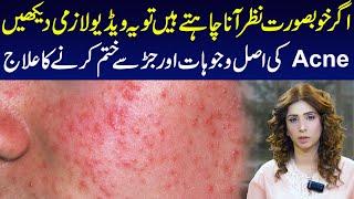 Understanding Acne: Causes and Effective Treatments | Dr Sahar Chawla
