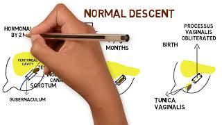 undescended testis crytorchidism