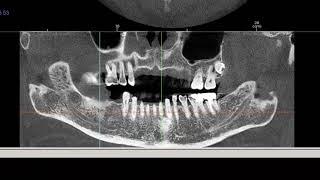 Tx STUDIO™: Implant Planning and Placement