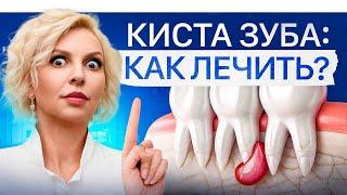 Киста зуба – можно ли вылечить без операции? Рекомендации стоматолога