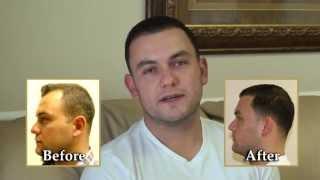 Dr. Brett Bolton Marine Gets a Hair Transplant