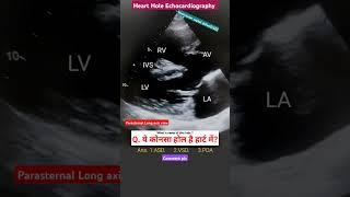 Heart hole  echo l Large VSD #echo #shorts