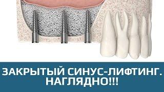 Закрытый синус-лифтинг. Этапы проведения закрытого синус-лифтинга