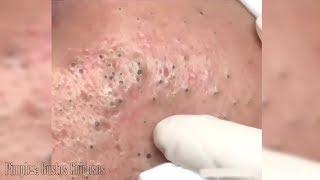 Extracción de enormes y llamativos puntos negros | Rostro repleto de blackhead