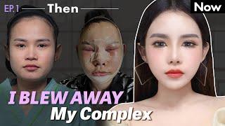 [SUB] She blew away her complex! | Rhinoplasty one week progression at NANA