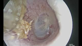 Underwater Drilling to repair Anterior Malleolar Fixation_Nirmal Patel