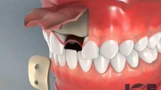 Bone Graft