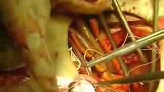 Mitral valve replacement