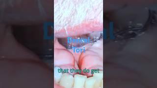 Bumps on the gums (dental tori)