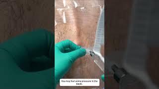Epidural at T9-T10: Preoperative for HIPEC Surgery #meded #or #jomi