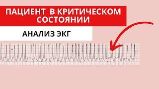 Пациент в критическом состоянии. Как анализировать ЭКГ?