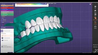 exocad - veneer and full crown design