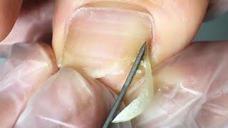 Nails embedded in feet suck, get a quick trim & care【DrZhang】