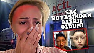 EN CİDDİ ALERJİLERDEN BİRİ; KAFAM ŞİŞTİ!! SAÇ BOYASI !!