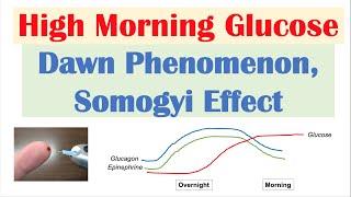 High Early Morning Glucose | Dawn Phenomenon & Somogyi Effect