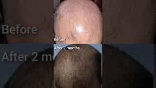 Traya Review After 2 months !! shedding phase  #traya #hairloss #hairlosstreatment