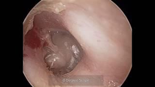 Right Contralateral dissection of Retrotympanic Retraction_Dr Nirmal Patel