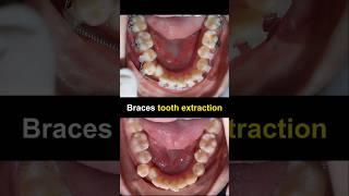 Tooth extraction when braces #braces #orthodontist #dentist