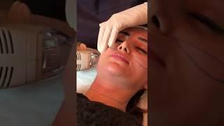 A video of a patient receiving Tixel "Plus"  treatment at  Perfect Eyes Ltd