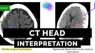 CT Head Interpretation for Beginners - OSCE Guide | UKMLA | CPSA | PLAB 2