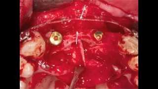 FAILURE  AT THE ANTERIOR  UPPER MAXILLA. RECONSTRUCTION WITH A BOXTECHNIQUE.mov