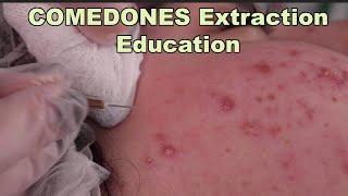 Comedones Extraction- Part 1 of the best acne treatment, before and after pictures included