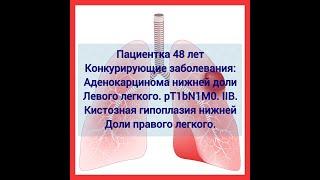 Рак левого легкого и гипоплазия правого легкого: у одного пациента: Что делать? (Базаров Д.В., РНЦХ)