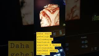 RAHİMDE PERDE ▶️ (UTERUS SEPTUM) 3 BOYUTLU ULTRASON GÖRÜNTÜSÜ?