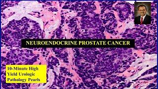 Neuroendocrine prostate cancer