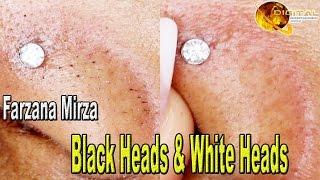 “Black Heads & White Heads” | Homemade Beauty Tips | Fashion Zone | HD Video