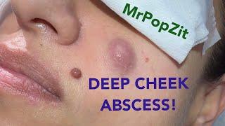 Deep cheek abscess drained! Purulence removed, pressure relieved, patient happy!