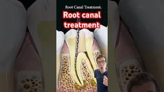 Doctor explains Root Canal treatment #shorts #dental