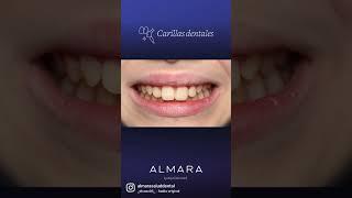 𝙃𝙞𝙥𝙤𝙥𝙡𝙖𝙨𝙞𝙖 𝙙𝙚 𝙏𝙪𝙧𝙣𝙚𝙧, qué es y cómo lo solucionamos - Clínica Almara Dental Madrid