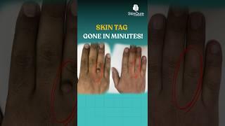 Skin Tag Removed in Minutes | Dr. Jangid at Skinqure  #Dermatology #DrJangid #Skinqure #shorts