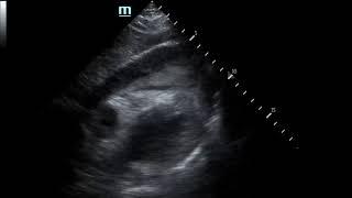 Pericardial clot  US  JETem 2019