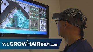 Hair Transplants: ARTAS Robotic FUE - We Grow Hair Indy - PAI Medical Group